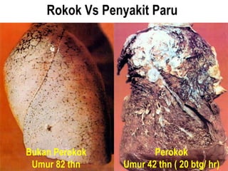 Rokok Vs Penyakit Paru
Bukan Perokok
Umur 82 thn
Perokok
Umur 42 thn ( 20 btg/ hr)
 