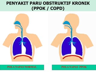 PENYAKIT PARU OBSTRUKTIF KRONIK
(PPOK / COPD)
POLA NAPAS NORMAL POLA NAPAS PPOK
 