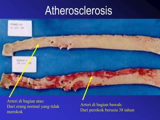 Atherosclerosis
Arteri di bagian atas:
Dari orang normal yang tidak
merokok
Arteri di bagian bawah:
Dari perokok berusia 38 tahun
 