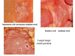 Squamous cell carcinoma stadium awal
Kanker oral stadium awal
Langit-langit
mulut perokok
 