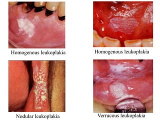 Homogenous leukoplakia Homogenous leukoplakia
Nodular leukoplakia Verrucous leukoplakia
 