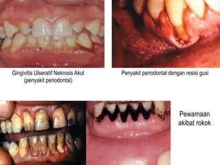 Gingivitis Ulseratif Nekrosis Akut
(penyakit periodontal)
Penyakit periodontal dengan resisi gusi
Pewarnaan
akibat rokok
 