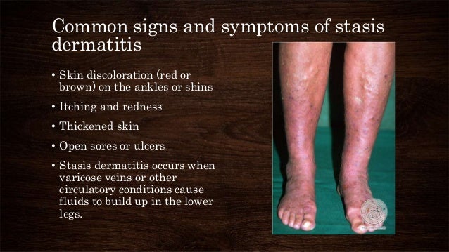 does tacrolimus cause itching