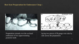Embrasure Rest Rpd Dand T for RPD.pptx design of partial dentures | PPTX
