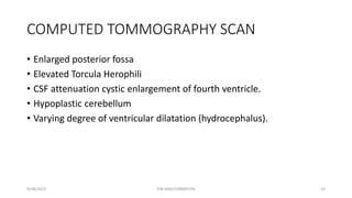 DANDYWALKER MALFORMATION | PDF