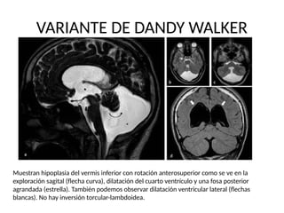 dandy walker NEUROCIRUGIA PEDIATRICA .pptx