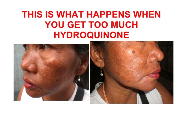 hydroquinone dangers happens