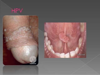 Dani apresenta HPV sintomas e prevenções 