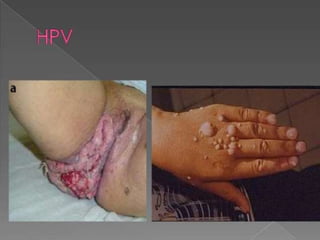 Dani apresenta HPV sintomas e prevenções 