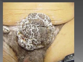 Dani apresenta HPV sintomas e prevenções 