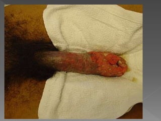 Dani apresenta HPV sintomas e prevenções 