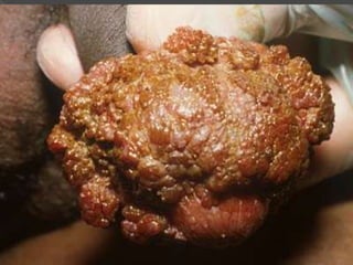 Dani apresenta HPV sintomas e prevenções 