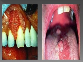 Dani apresenta HPV sintomas e prevenções 