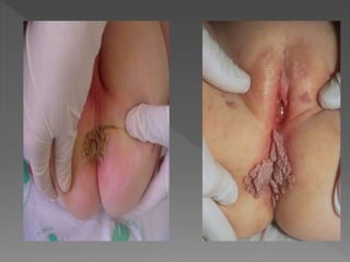 Dani apresenta HPV sintomas e prevenções 