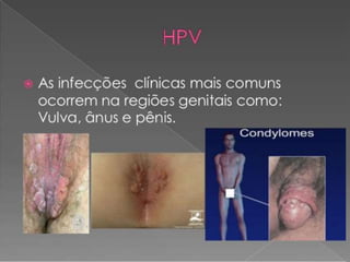 Dani apresenta HPV sintomas e prevenções 