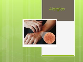 Alergias
 