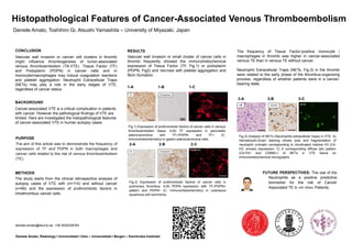 CONCLUSION
Vascular wall invasion or cancer cell clusters in thrombi
might influence thrombogenesis of tumor-associated
venous thromboembolism (TA-VTE). Tissue Factor (TF)
and Podoplanin (PDPN) in cancer cells and in
monocyte/macrophages may induce coagulation reactions
and platelet aggregation. Neutrophil Extracellular Traps
(NETs) may play a role in the early stages of VTE,
regardless of cancer status.
PURPOSE
The aim of this article was to demonstrate the frequency of
expression of TF and PDPN in both macrophages and
cancer cells related to the risk of venous thromboembolism
(TE).
Fig.1) Expression of prothrombotic factors of cancer cells in venous
thromboembolism tissue. A-B) TF expression in pancreatic
adenocarcinoma with TF+/PDPN- and TF+ (C,
immunohistochemistry) in gastric adenocarcinoma cells.
Histopathological Features of Cancer-Associated Venous Thromboembolism
Daniele Amato, Toshihiro Gi, Atsushi Yamashita – University of Miyazaki, Japan
FUTURE PERSPECTIVES: The use of the
Neutrophils as a positive predictive
biomarker for the risk of Cancer
Associated TE in «in vivo» Patients.
Daniele Amato, Radiology I Universitetet I Oslo – Universitetet i Bergen – Karolinska Institutet
daniele.amato@stud.ki.se +39 3935236763
BACKGROUND
Cancer-associated VTE is a critical complication in patients
with cancer. However the pathological findings of VTE are
limited. Here are investigated the histopathological features
of cancer-associated VTE in human autopsy cases.
1-A 1-B 1-C
2-A 2-B 2-C
Fig.2) Expression of prothrombotic factors of cancer cells in
pulmonary thrombus. A-B) PDPN expression with TF-/PDPN+
pattern and PDPN+ (C, immunohistochemistry) in cutaneous
squamous cell carcinoma.
Fig.3) Analysis of NETs (Neutrophils extracellular traps) in VTE. A)
Hematoxylin-Eosin staining shows lysis and fragmentation of
neutrophil cromatin corresponding to citrullinated histone H3 (Cit-
H3, arrows) expression; C) A corresponding diffuse lytic pattern
(Cit-H3+ and CD66b+) of NETs in VTE tissue on
immunohistochemical micrographs.
METHODS
The study starts from the clinical retrospective analysis of
autopsy cases of VTE with (n=114) and without cancer
(n=66) and the expression of prothrombotic factors in
intrathrombus cancer cells.
3-A 3-B 3-C
RESULTS
Vascular wall invasion or small cluster of cancer cells in
thrombi frequently showed the immunohistochemical
expression of Tissue Factor (TF, Fig.1) or podoplanin
(PDPN, Fig2) and necrosis with platelet aggregation and
fibrin formation.
The frequency of Tissue Factor-positive monocyte /
macrophages in thrombi was higher in cancer-associated
venous TE than in venous TE without cancer.
Neutrophil Extracellular Traps (NETs, Fig.3) in the thrombi
were related to the early phase of the thrombus-organizing
process, regardless of whether patients were in a cancer-
bearing state.
 