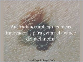 Australianos aplican técnicas
innovadoras para evitar el avance
del melanoma
Daniel Esgardo Rangel Barón
 
