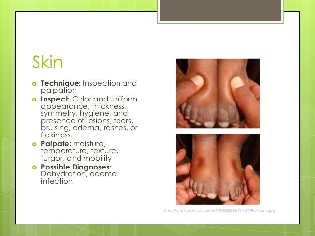 nutrition focused physical assessment charting skin turgor