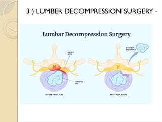 spinal cord compression , spinal problems ppt | PPTX