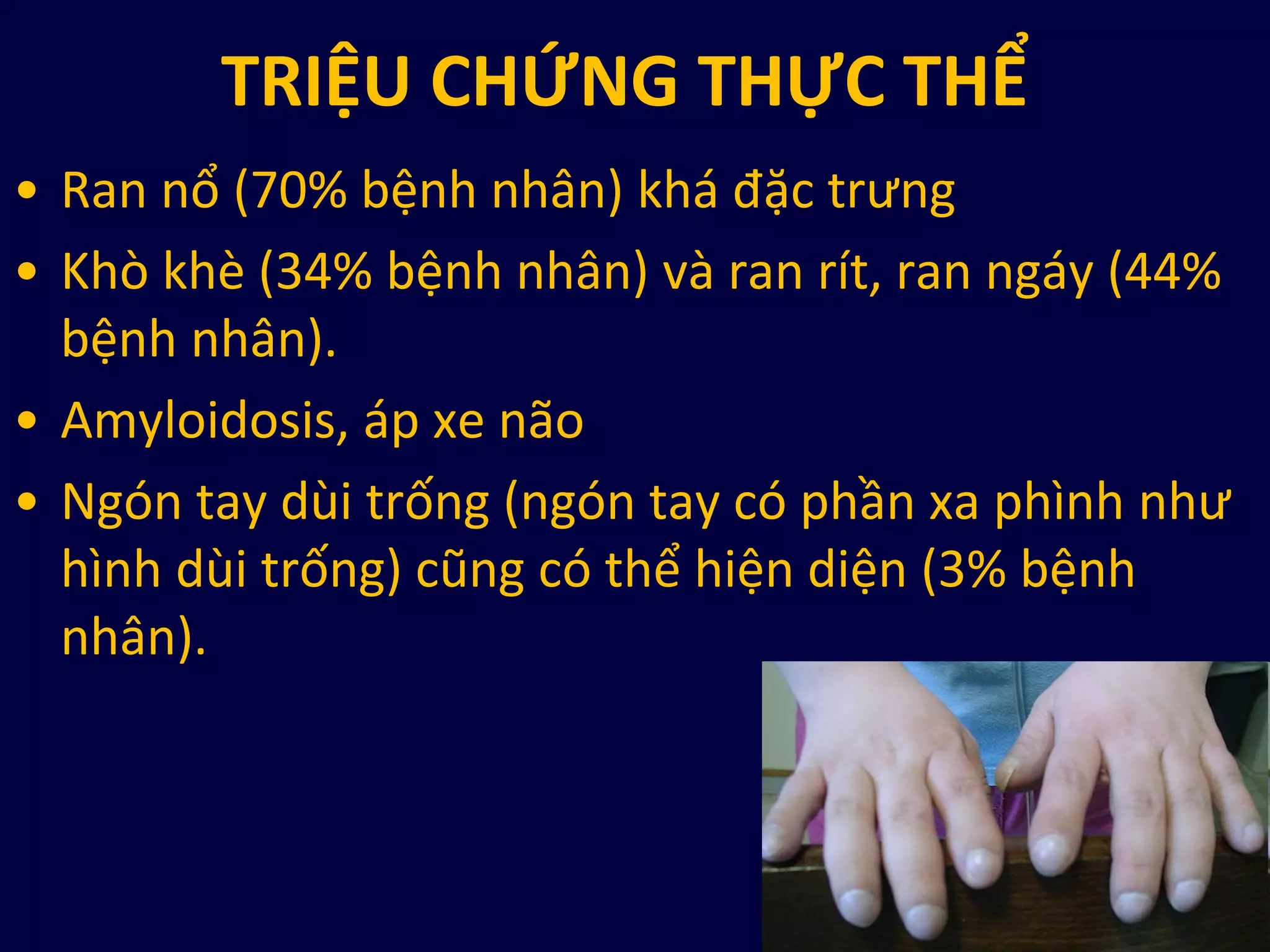 TRIỆU CHỨNG THỰC THỂ
• Ran nổ (70% bệnh nhân) khá đặc trưng
• Khò khè (34% bệnh nhân) và ran rít, ran ngáy (44%
bệnh nhân).
• Amyloidosis, áp xe não
• Ngón tay dùi trống (ngón tay có phần xa phình như
hình dùi trống) cũng có thể hiện diện (3% bệnh
nhân).
 