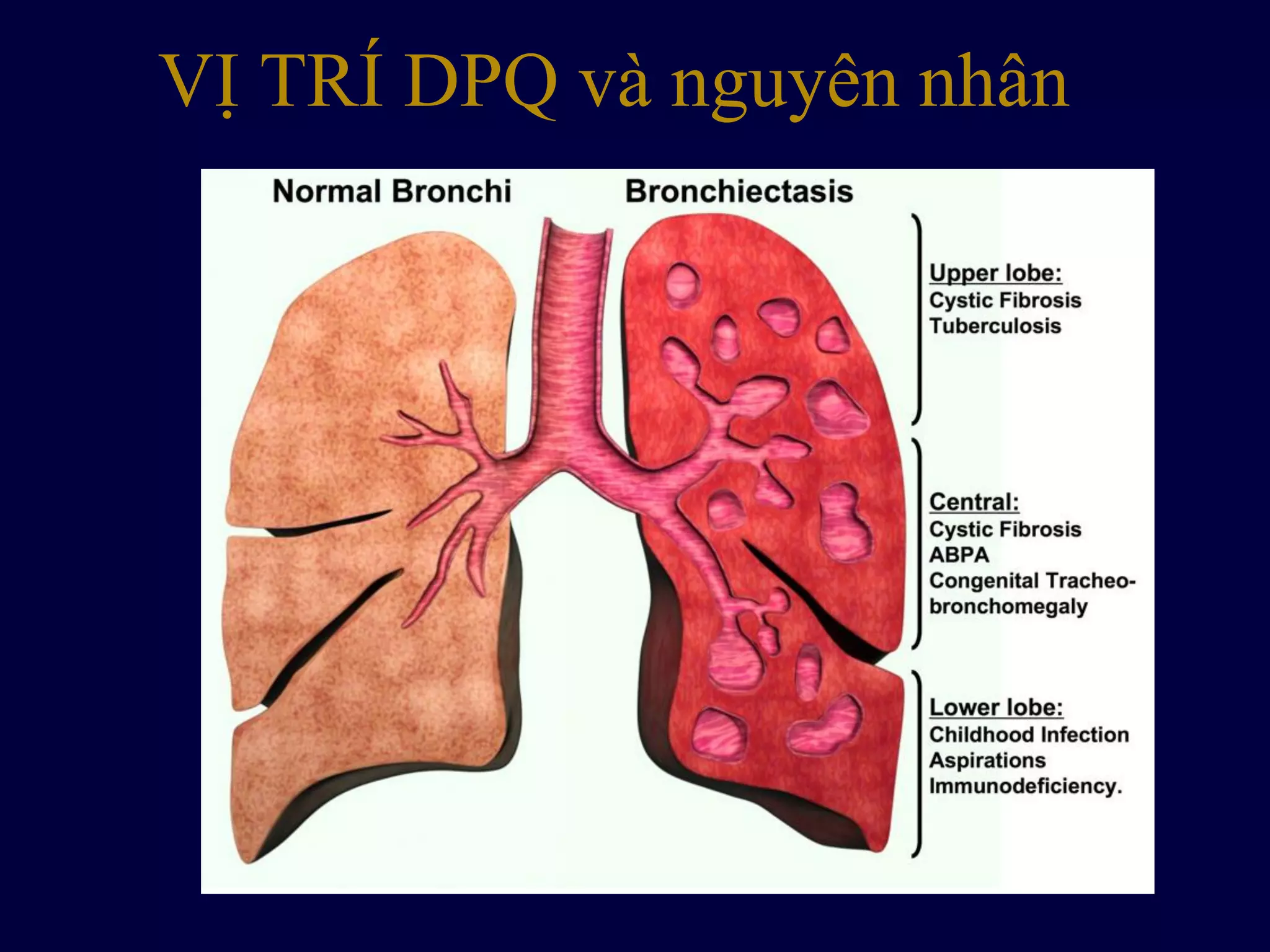 VỊ TRÍ DPQ và nguyên nhân
 