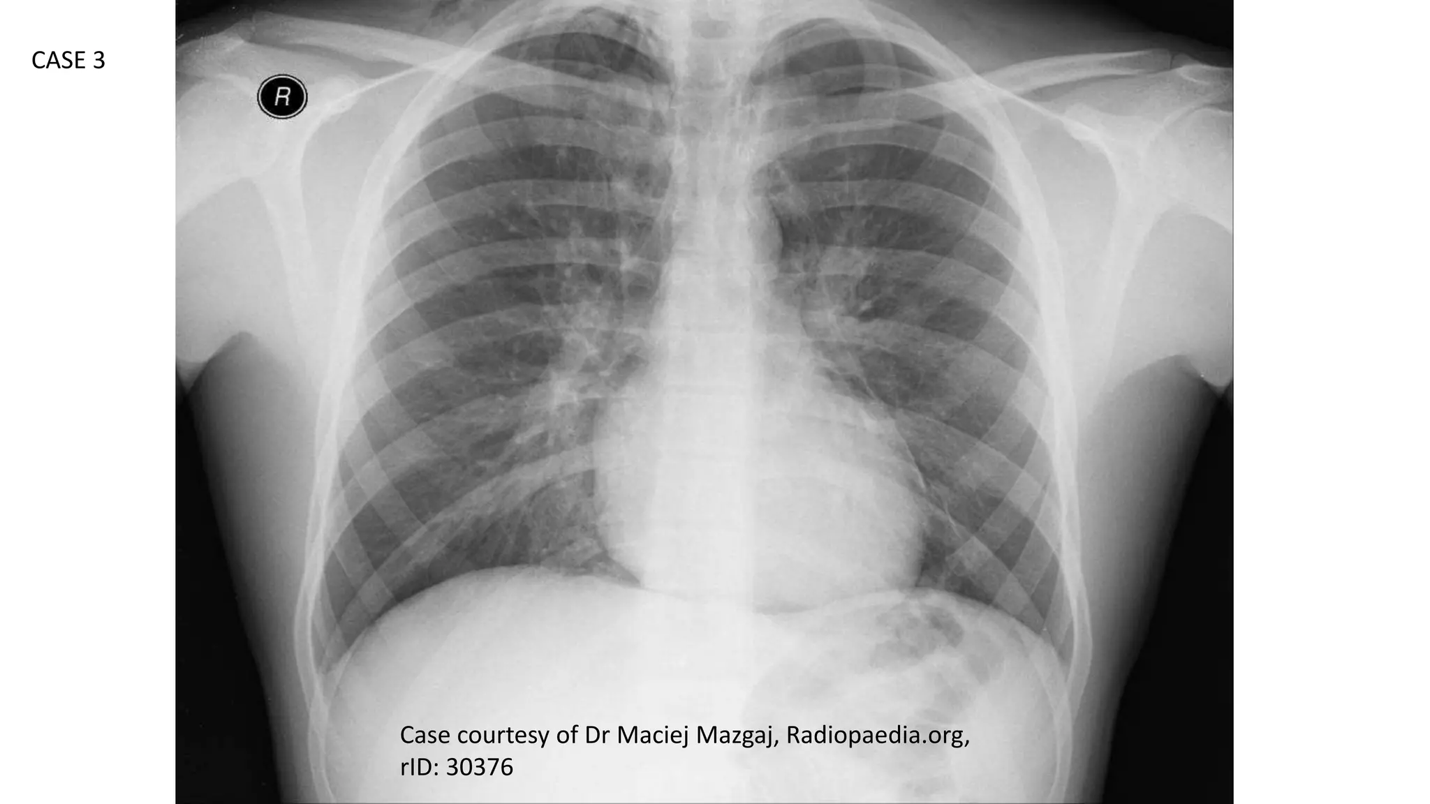 Case courtesy of Dr Maciej Mazgaj, Radiopaedia.org,
rID: 30376
CASE 3
 