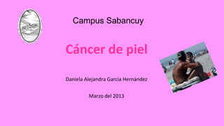 Cáncer de piel
Daniela Alejandra García Hernández
Marzo del 2013
Campus Sabancuy
 