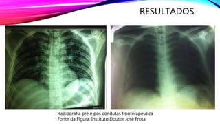 RESULTADOS
Radiografia pré e pós condutas fisioterapêutica
Fonte da Figura: Instituto Doutor José Frota
 