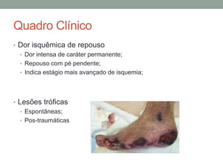 Quadro Clínico
• Dor isquêmica de repouso
• Dor intensa de caráter permanente;
• Repouso com pé pendente;
• Indica estágio mais avançado de isquemia;
• Lesões tróficas
• Espontâneas;
• Pos-traumáticas
 