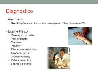 Diagnóstico
• Anamnese
• Claudicação intermitente, dor em repouso, úlcera/necrose???
• Exame Físico:
• Rarefação de pelos;
• Pele brilhante;
• Cianose;
• Palidez;
• Edema extremidades;
• Atrofia muscular
• Lesões tróficas;
• Pulsos ausentes;
• Sopros sistólicos;
 