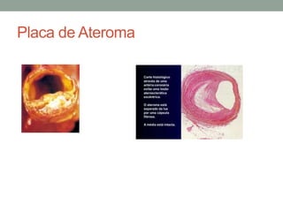 Placa de Ateroma
 