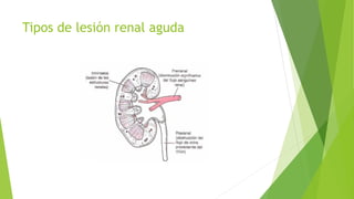 Tipos de lesión renal aguda
 