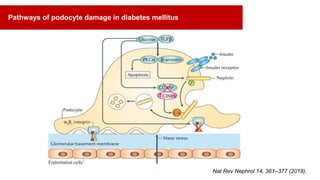 Nat Rev Nephrol 14, 361–377 (2018).
Pathways of podocyte damage in diabetes mellitus
 