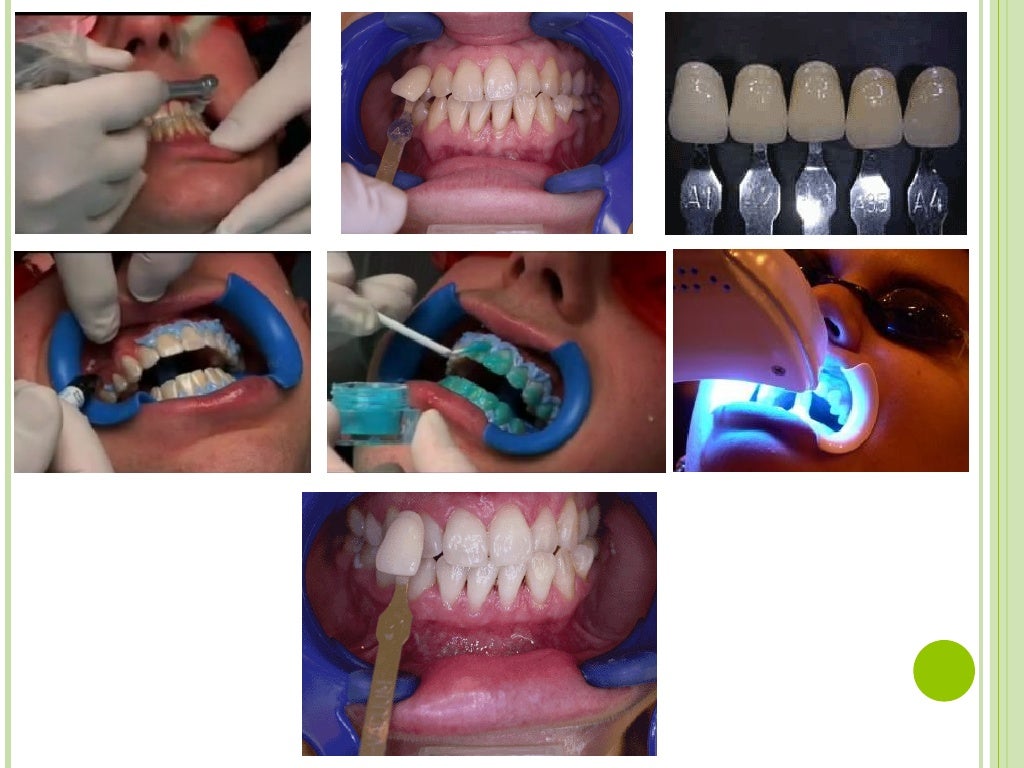 Dental Bleaching
