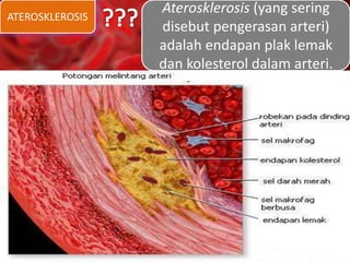 ATEROSKLEROSIS
Aterosklerosis (yang sering
disebut pengerasan arteri)
adalah endapan plak lemak
dan kolesterol dalam arteri.
 