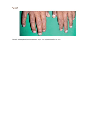 Darier disease: candy-cane nails and hyperkeratotic papules