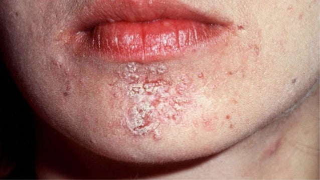 Image result for darier's disease pictures