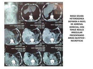 MASA SOLIDA
HETEROGENEA
DEFINIDA A NIVEL
DE ADRENAL
DERECHA, CON
TENUE REALCE
IRREGULAR
PRESENTANDO
AREAS QUISTICO -
NECROTICAS
 