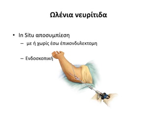 Ωλένια νευρίτιδα 
• In Situ αποσυμπίεση 
– με ή χωρίς έσω έπικονδυλεκτομη 
– Ενδοσκοπική 
 