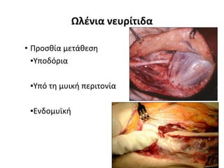 Ωλένια νευρίτιδα 
• Προσθία μετάθεση 
▪Υποδόρια 
▪Υπό τη μυική περιτονία 
▪Ενδομυϊκή 
 