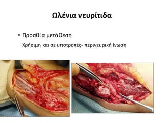 Ωλένια νευρίτιδα 
• Προσθία μετάθεση 
Χρήσιμη και σε υποτροπές- περινευρική ίνωση 
 