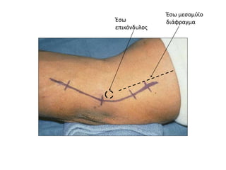 Έσω 
επικόνδυλος 
Έσω μεσομύϊο 
διάφραγμα 
 