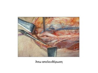 Άπω απελευθέρωση 
 