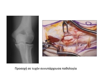 Προσοχή σε τυχόν συνυπάρχουσα παθολογία 
 