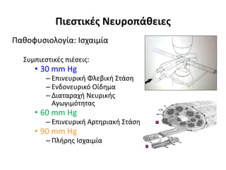 Πιεστικές Νευροπάθειες 
Παθοφυσιολογία: Ισχαιμία 
Συμπιεστικές πιέσεις: 
• 30 mm Hg 
– Επινευρική Φλεβική Στάση 
– Ενδονευρικό Οίδημα 
– Διαταραχή Νευρικής 
Αγωγιμότητας 
• 60 mm Hg 
– Επινευρική Αρτηριακή Στάση 
• 90 mm Hg 
– Πλήρης Ισχαιμία 
 