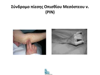 Σύνδρομο πίεσης Οπισθίου Μεσόστεου ν. 
(PIN) 
 