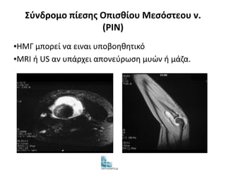 Σύνδρομο πίεσης Οπισθίου Μεσόστεου ν. 
(PIN) 
▪ΗΜΓ μπορεί να ειναι υποβοηθητικό 
▪MRI ή US αν υπάρχει απονεύρωση μυών ή μάζα. 
 