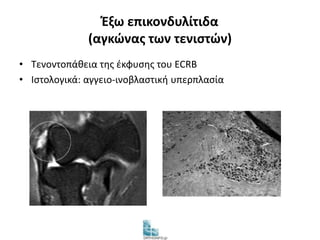 Έξω επικονδυλίτιδα 
(αγκώνας των τενιστών) 
• Τενοντοπάθεια της έκφυσης του ECRB 
• Ιστολογικά: αγγειο-ινοβλαστική υπερπλασία 
 
