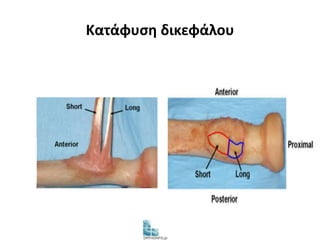 Κατάφυση δικεφάλου 
 